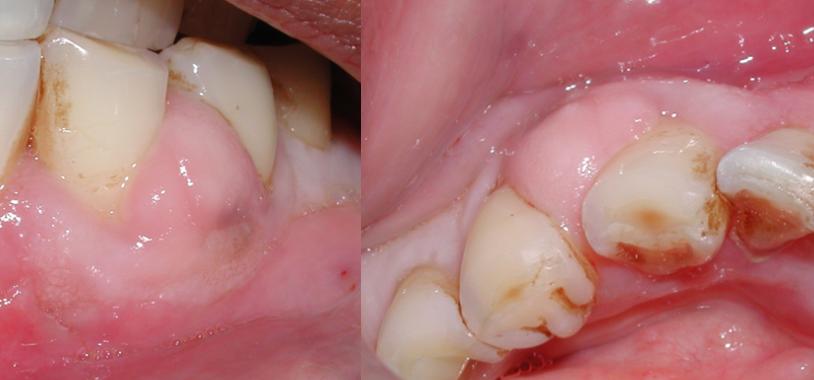 Abces parodontal forme sur la gencive