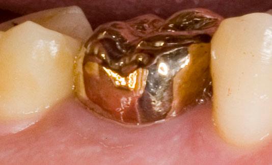 Couronne en or dentaire, vue laterale