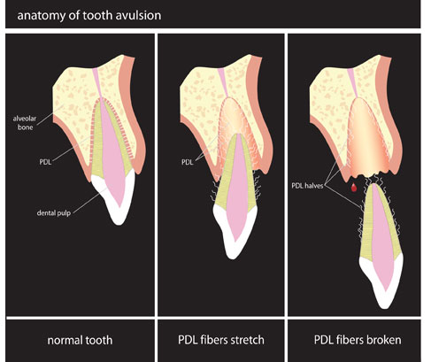 Dent Expulsee : Protocole de Reimplantation en 30 Minutes
