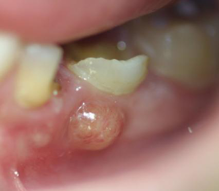 Abces dentaire visible sur la gencive